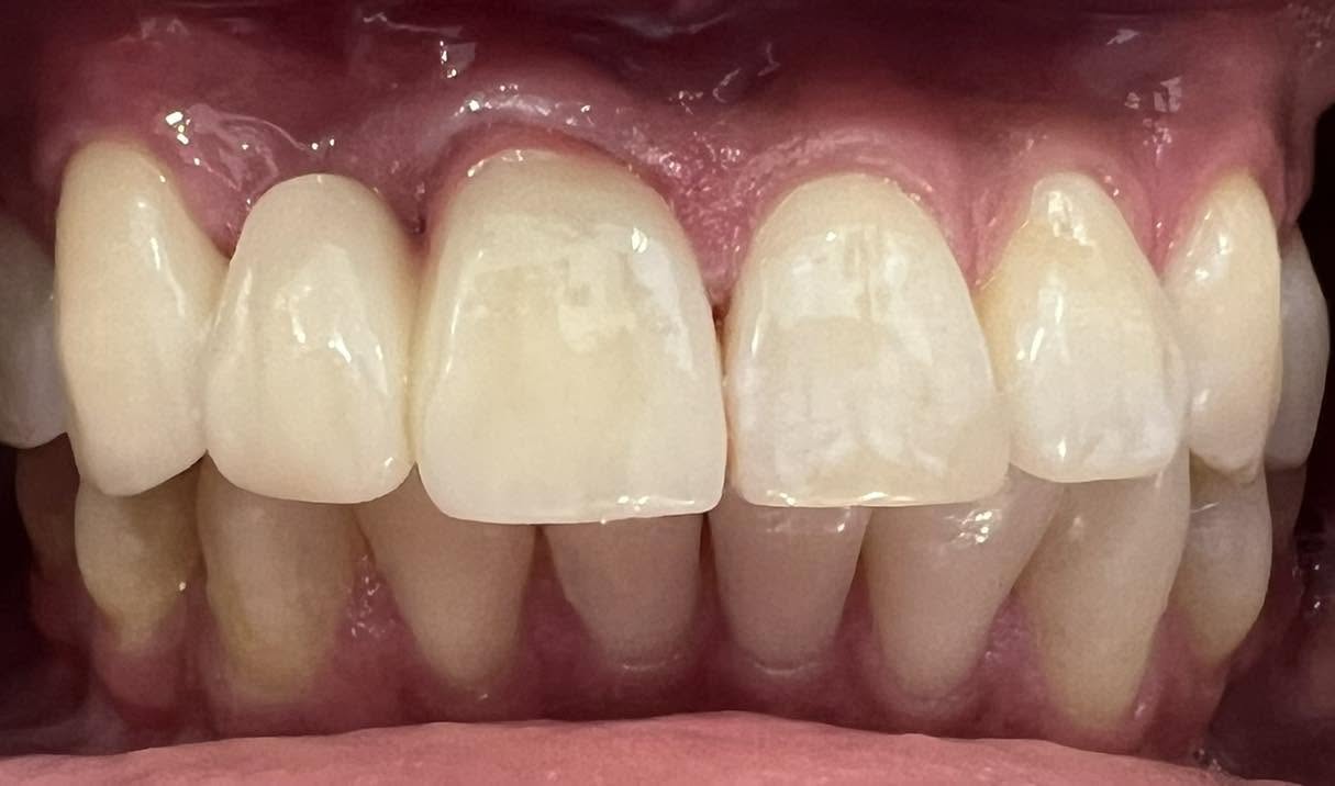 After treatment