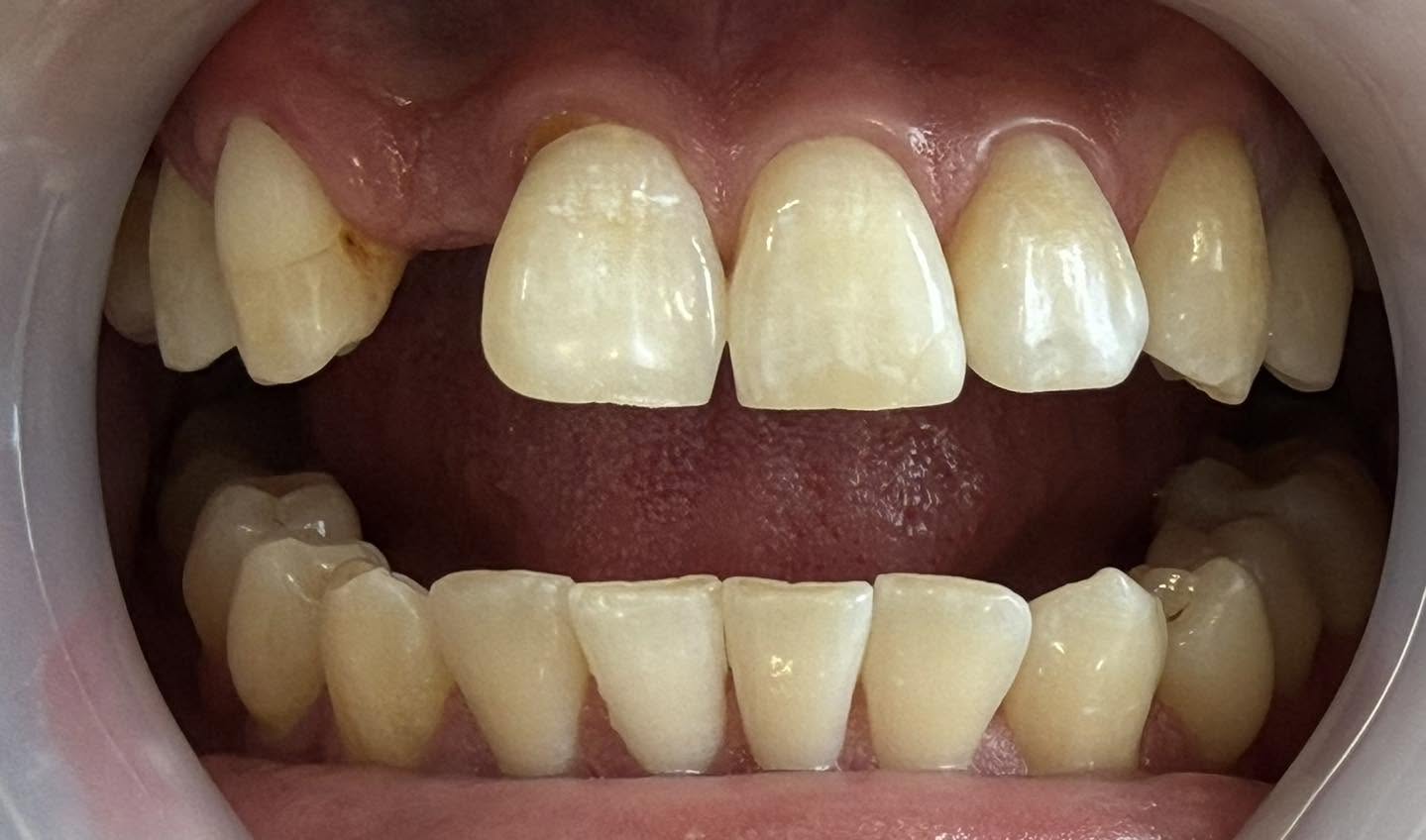 Before treatment